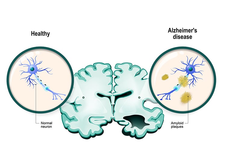 Alzheimer's disease Neurons and brain