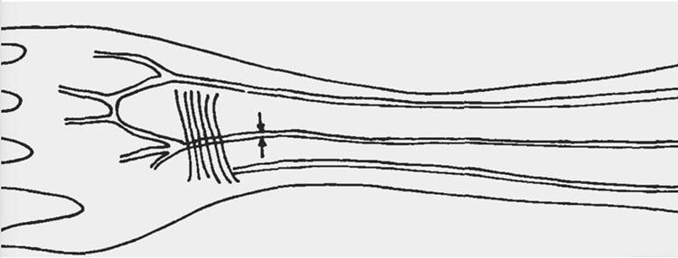 Median Artery Evolution