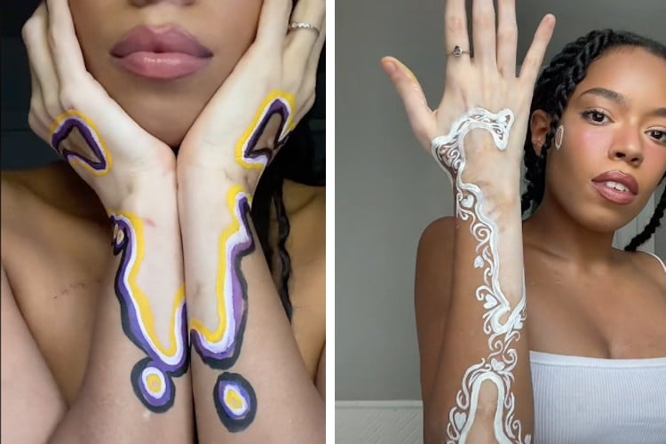 Woman With Vitiligo Transforms Her Skin Into Art Spots
